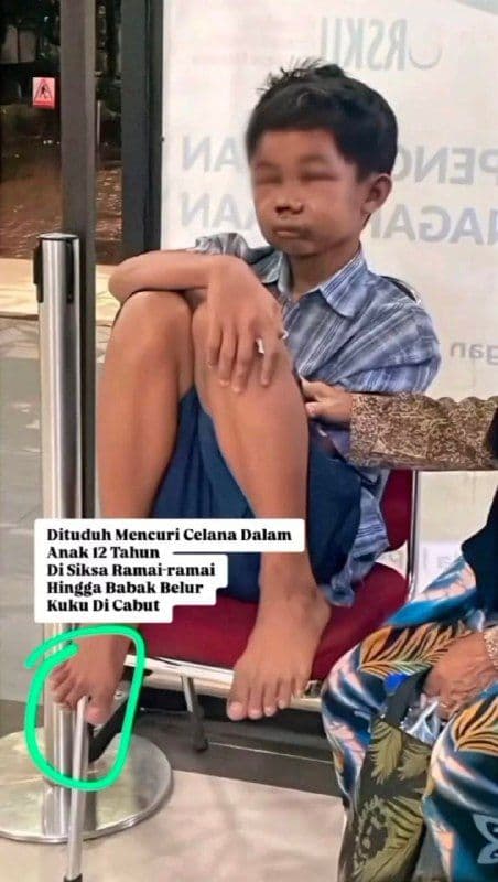 Kisah Pilu Anak Desa Banyusri: Luka Fisik Parah dan Trauma Psikologis